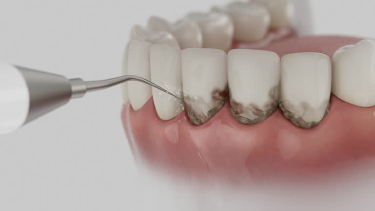 Trusted Wisdom Tooth Removal service in Crescent City, CA - Dentist Open Now
